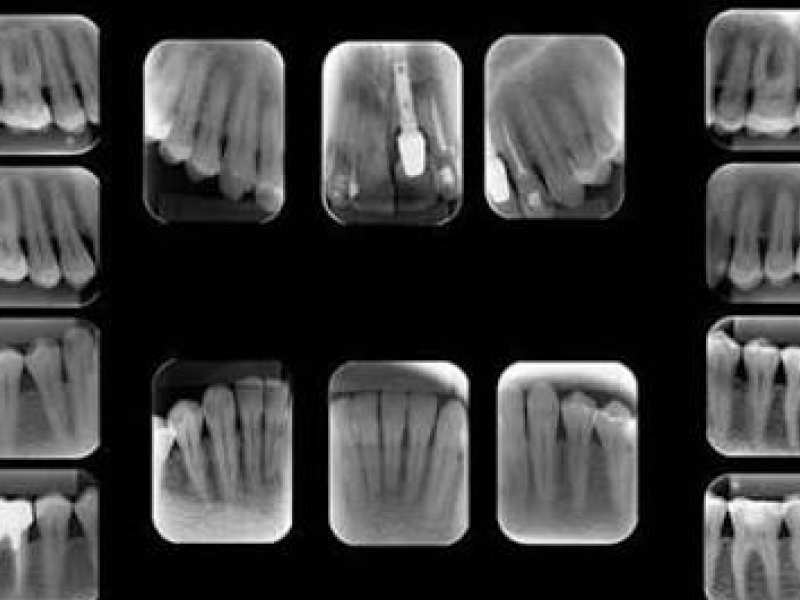 Radiografia periapical