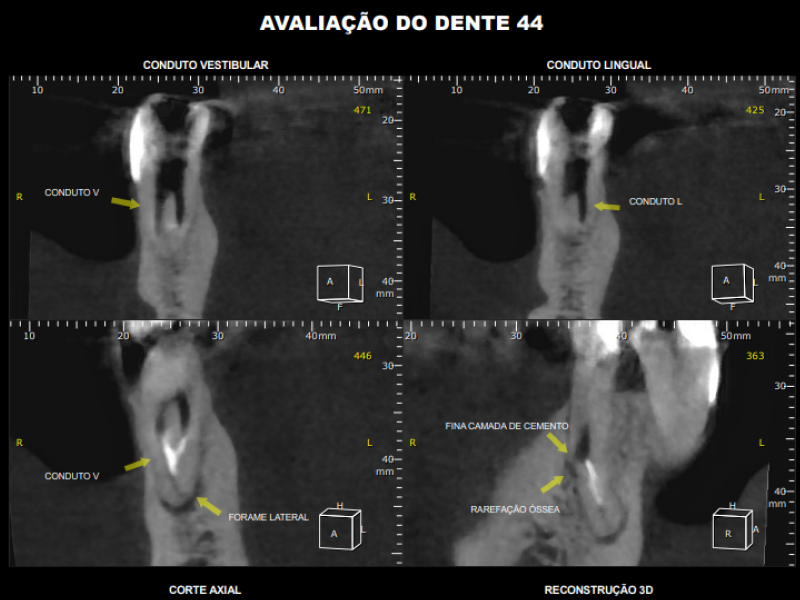 Tomografia (CBCT)